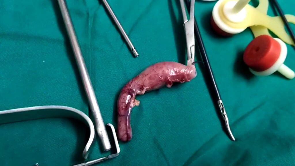 Appendix removal