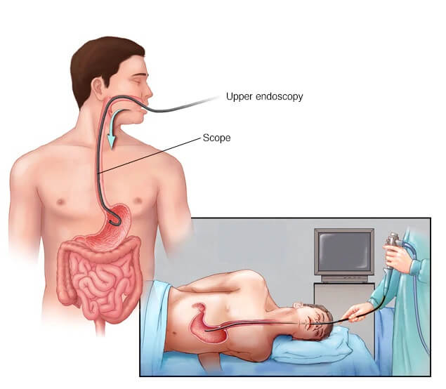 gastroscopy