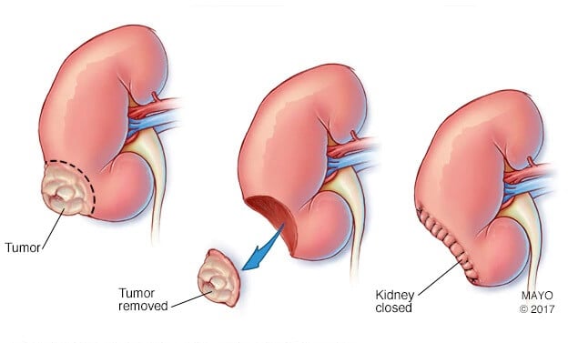 Nephrectomy