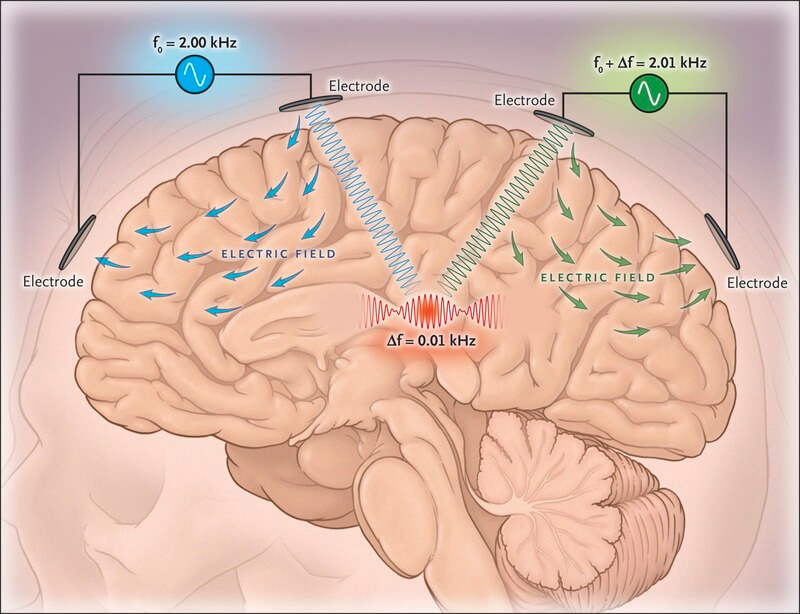 nejmcibr1707165_f1-jpeg