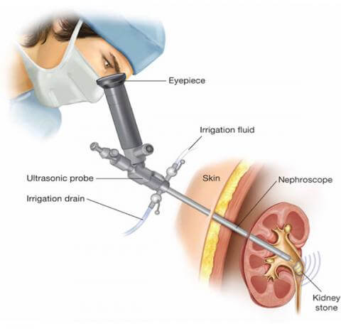 PCNL (percutaneous nephrolithotomy) kidney stone