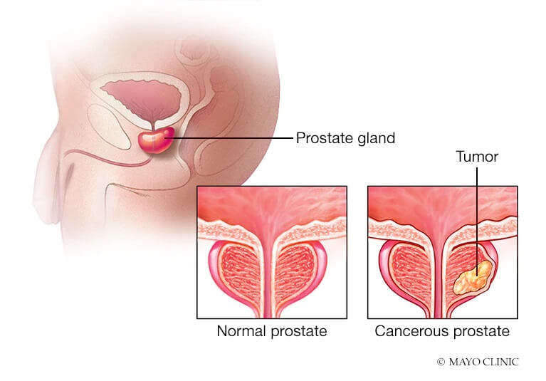 Open Radical Prostatectomy