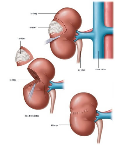 Nephrectomy