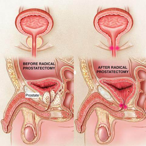 Open Radical Prostatectomy