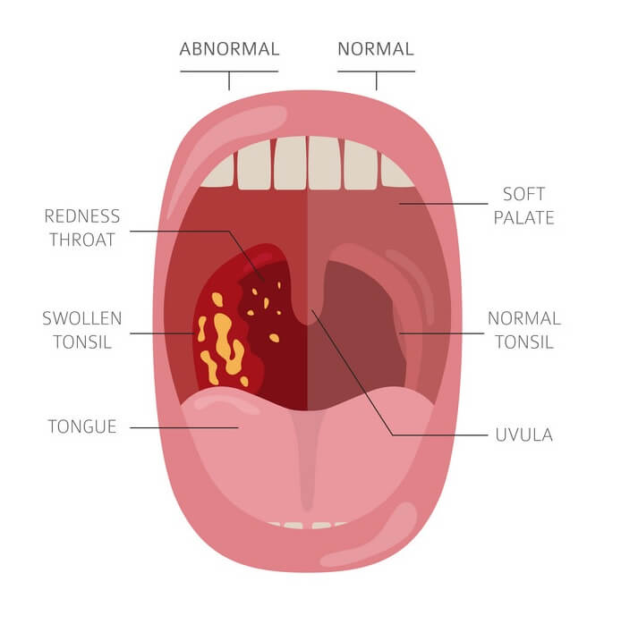 Tonsillectomy