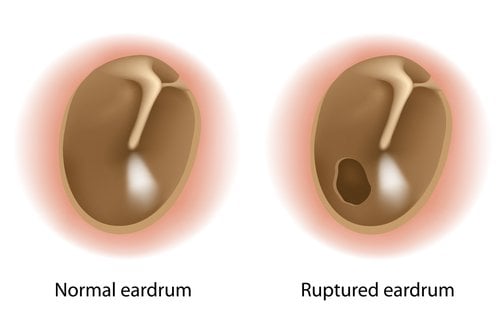 tympanoplasty