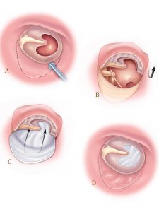 Tympanoplasty |Eardrum Repair |Diagnosis/Preparation |Free Consultation