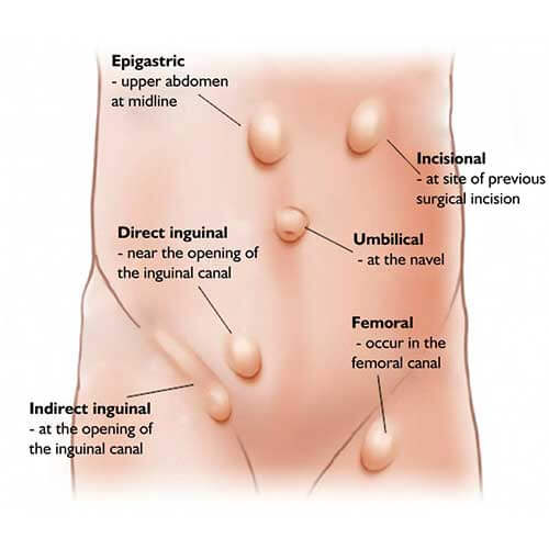 hernia types, symptoms