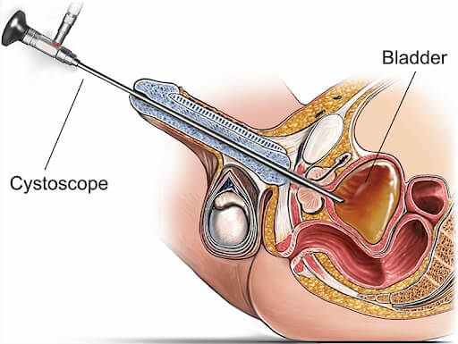 Cystoscopy