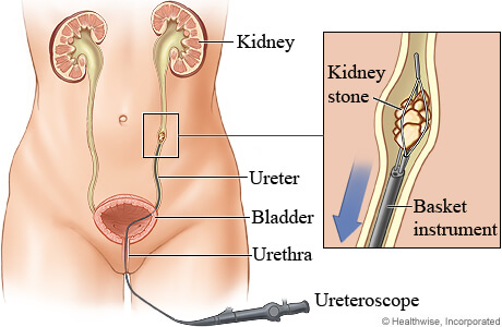 transurethral lithotomy TUL