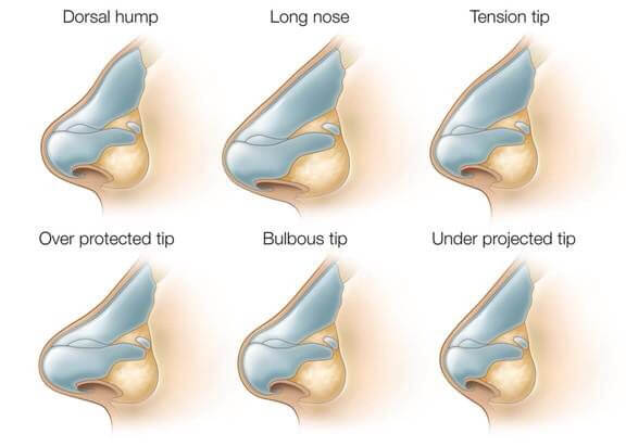 Rhinoplasty nose job in Iran