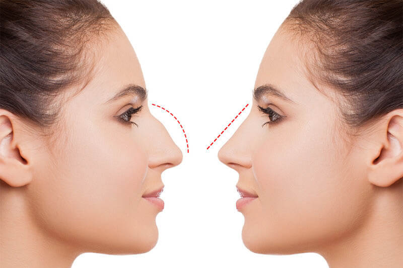 a-guide-to-rhinoplasty