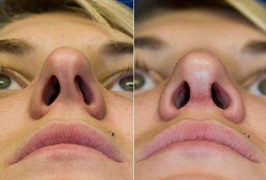 Rhinoplasty nose job in Iran