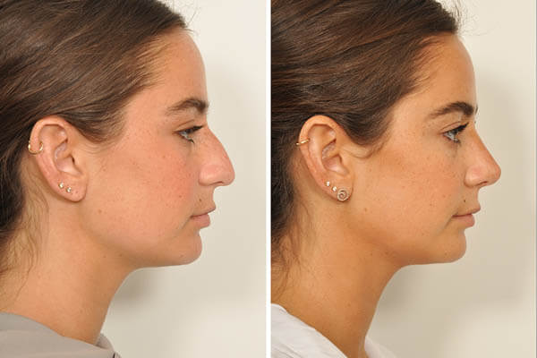 Rhinoplasty nose job in Iran