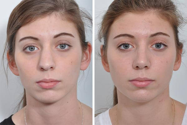 Rhinoplasty nose job