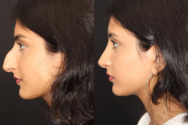 Rhinoplasty nose job in Iran