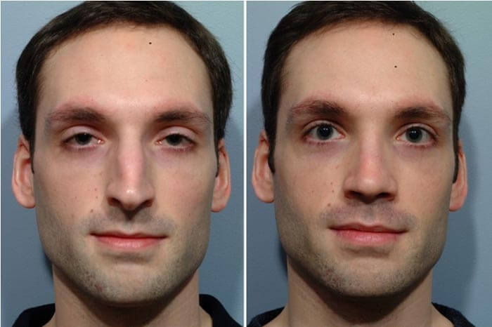 rhinoplasty-before-and-after-2