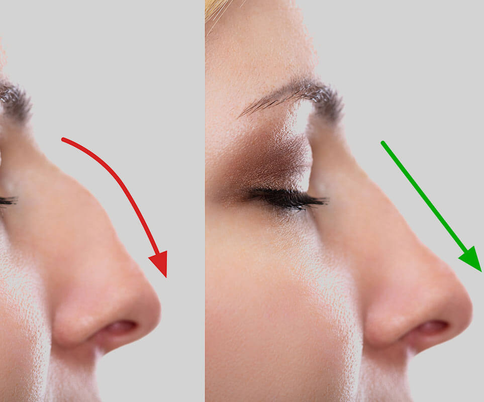 rhinoplasty-surgery-in-raleigh