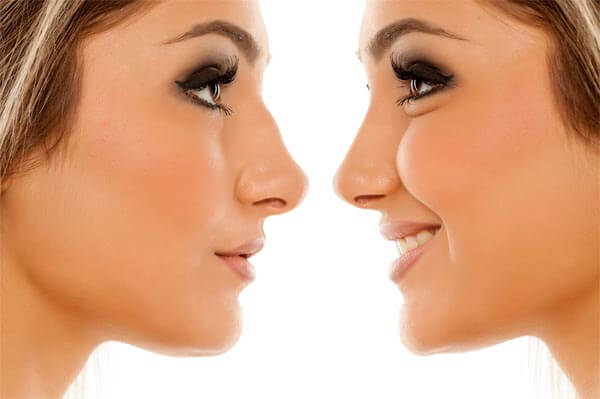 Rhinoplasty nose job