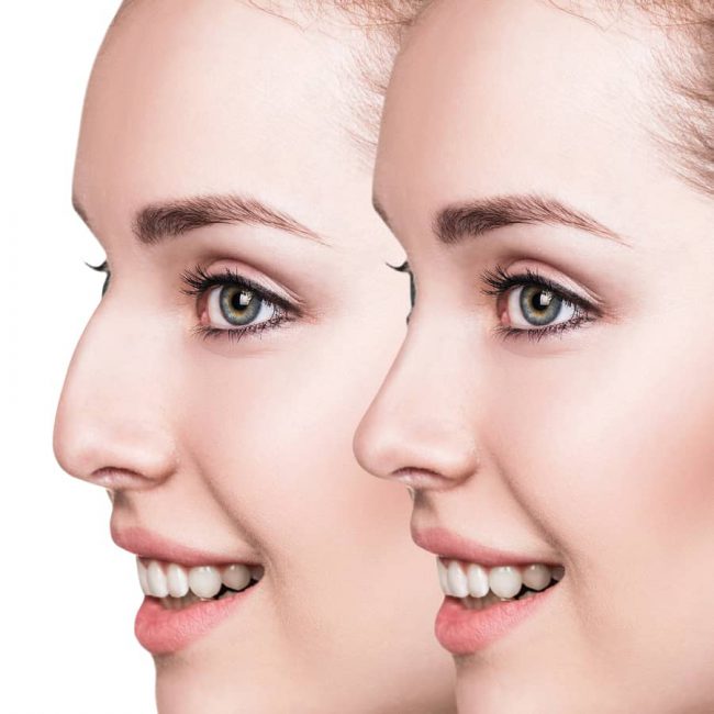 Rhinoplasty nose job in Iran