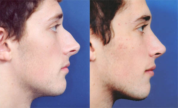 Rhinoplasty nose job