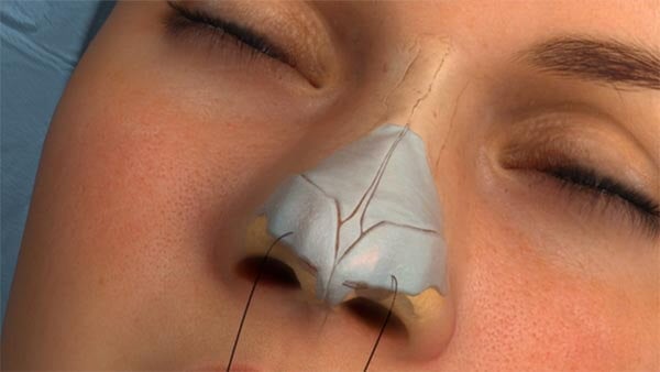 Rhinoplasty nose job