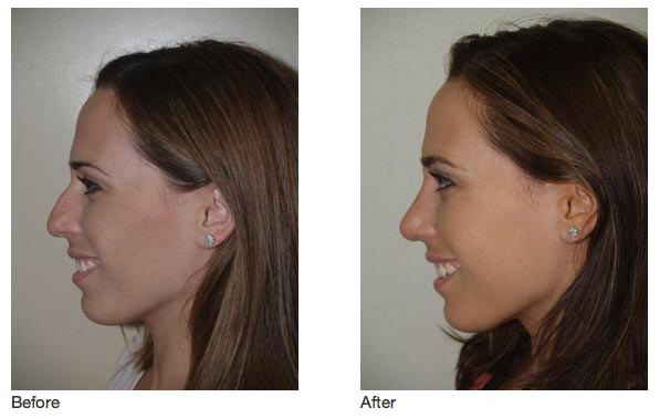 Rhinoplasty nose job in Iran