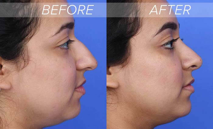 Rhinoplasty nose job in Iran