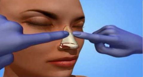 Rhinoplasty nose job in Iran