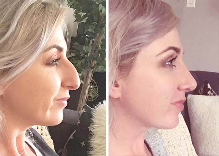 nose-before-after-1