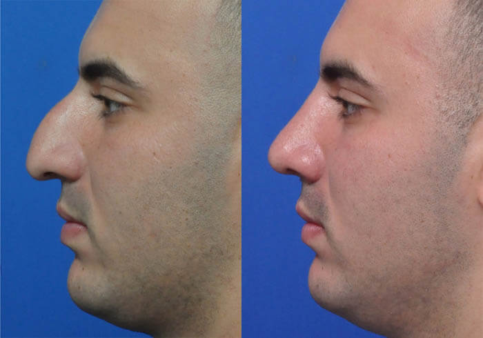 Rhinoplasty nose job in Iran