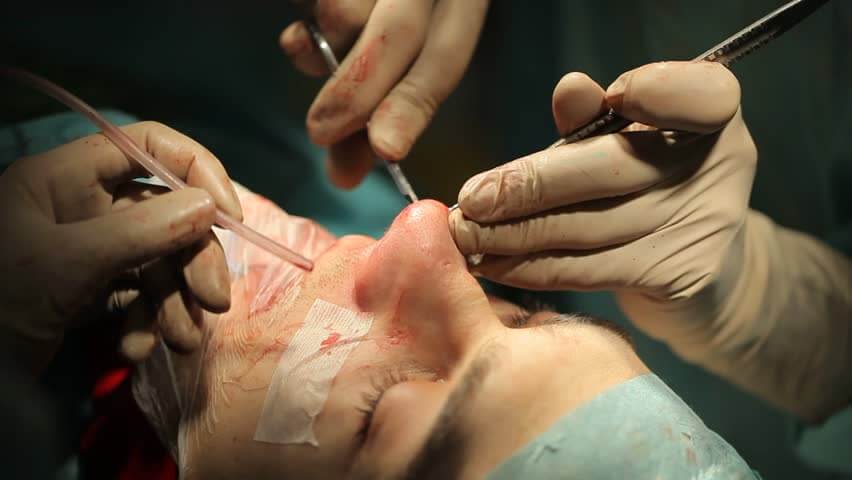 Rhinoplasty nose job in Iran