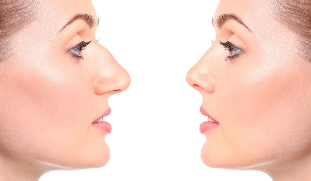 Rhinoplasty nose job