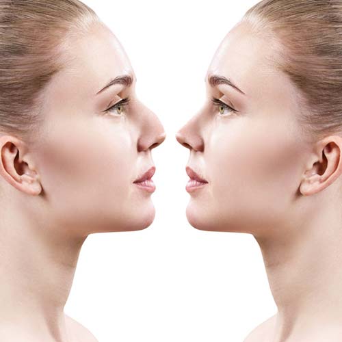 rhinoplasty-fairfax-va