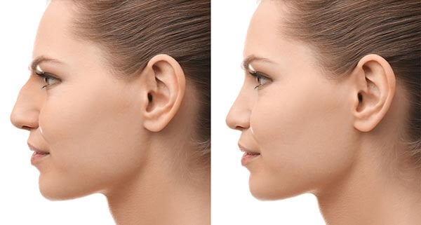 Rhinoplasty nose job in Iran