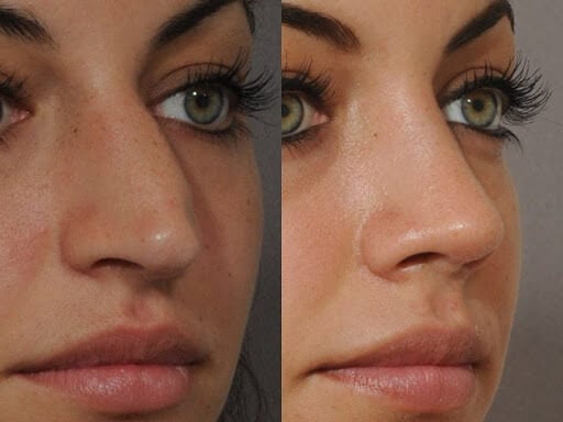 Rhinoplasty nose job in Iran