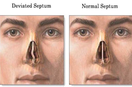 Rhinoplasty nose job in Iran