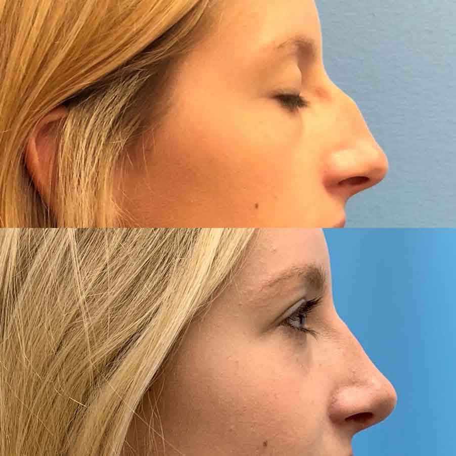 Rhinoplasty nose job in Iran