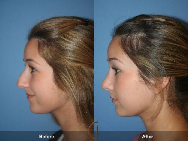 Rhinoplasty nose job in Iran