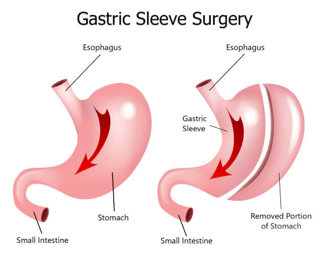 gastric sleeve surgery in Iran