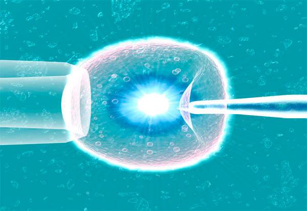 IVF in Iran