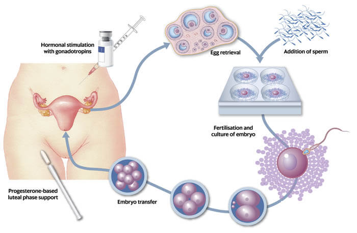 IVF in Iran