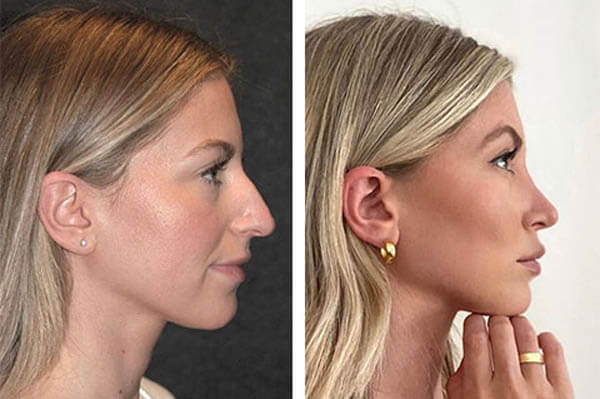 Rhinoplasty nose job in Iran