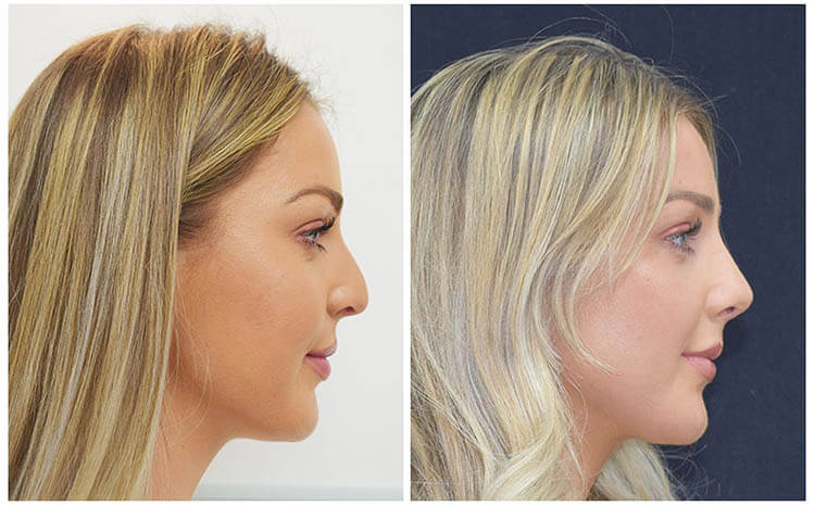 Rhinoplasty nose job in Iran