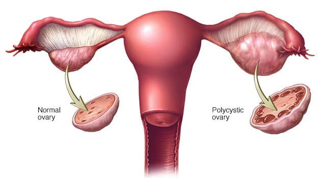 Egg donation in Iran