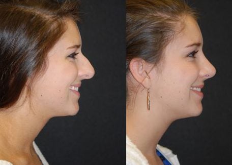 Rhinoplasty nose job in Iran