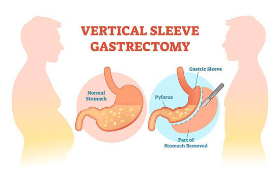 gastric sleeve surgery in Iran