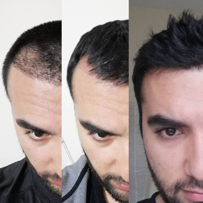 hair transplant in Iran