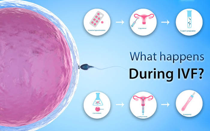 IVF in Iran