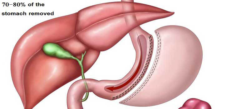 gastric sleeve surgery in Iran